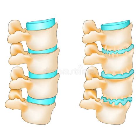 Osteophyte Formation Stock Illustrations – 33 Osteophyte Formation ...