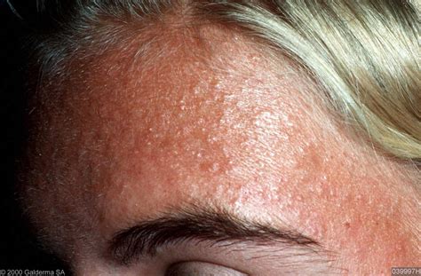 Facial Folliculitis Pictures Photos