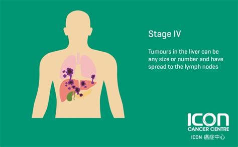 Liver Cancer — Icon Cancer Centre Hong Kong