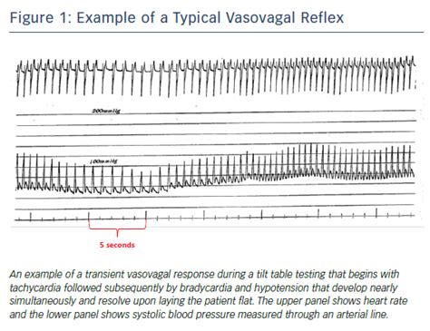 Figure 1 Example Of A Typical Vasovagal Reflex Radcliffe Cardiology