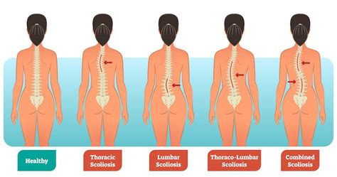 Кабинет лечения сколиоза – Центр лечения позвоночника и суставов ...