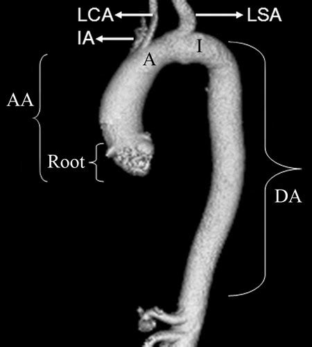 Multidetector Ct Of Thoracic Aortic Aneurysms Radiographics