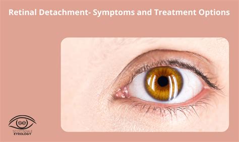 What Are The Symptoms Of Retinal Detachment