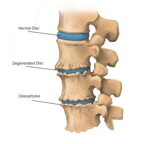 Herniated Disc Causes Signs Treatments Artofit