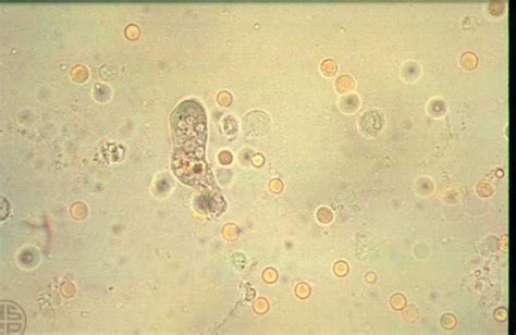 Entamoeba Histolytica