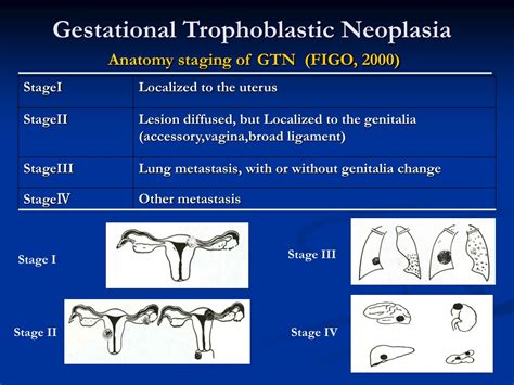 Ppt Chapter Gestational Trophoblastic Disease Powerpoint