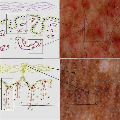 Schematic Diagram Showing A Histopathological And Dermoscopic