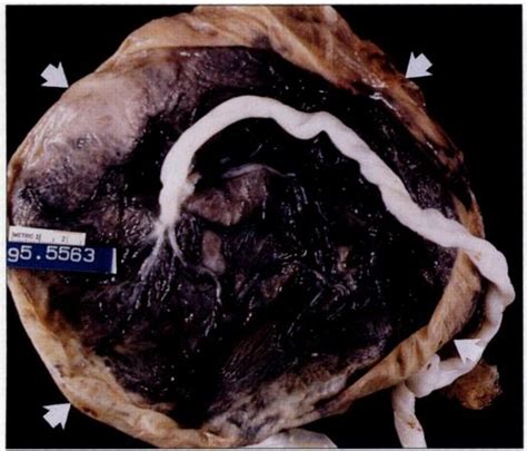 Gross Specimens Of Circumvallate Placentas A Fetal Surface Of Download Scientific Diagram