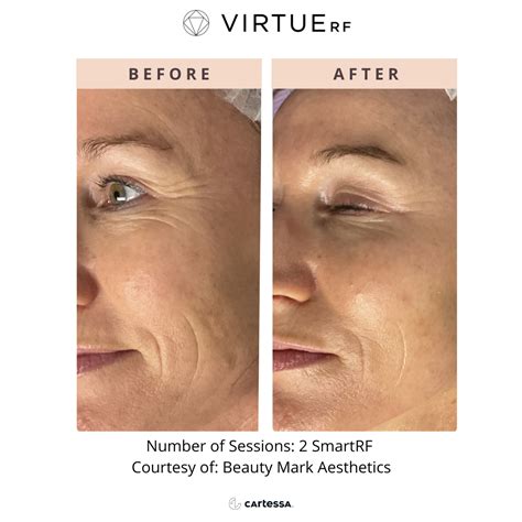 Virtue Rf Microneedling Renew Medical Spa