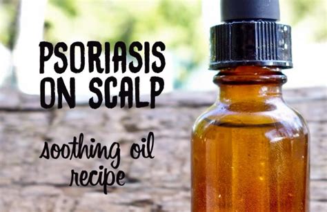 Psoriasis on Scalp: Try this Soothing & Moisturizing DIY Recipe