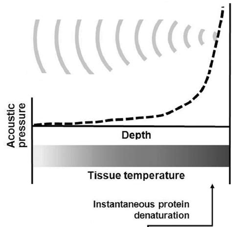 Focal High Intensity Focused Ultrasound For Prostate Cancer Intechopen