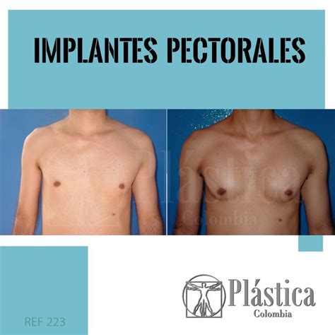 Antes y después de implantes pectorales Implante Cirugia plástica