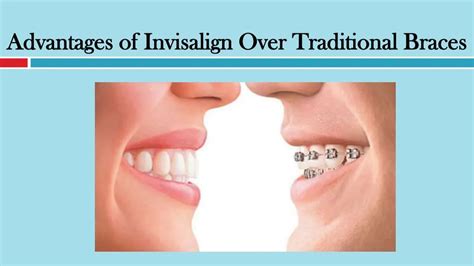 Ppt Advantages Of Invisalign Over Traditional Braces Powerpoint