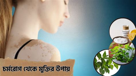 চর্মরোগ থেকে মুক্তির উপায় জেনে নিন Totthobicitra