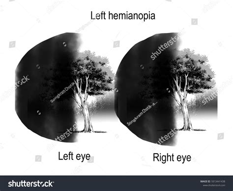 Different Patterns Visual Field Defects Neurological Stock Illustration 1813441438 | Shutterstock