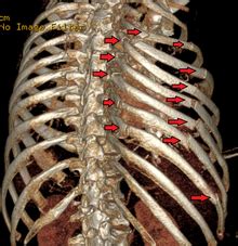 Fractura Costal Cirugia De Columna En Matamoros