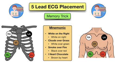 How to Place a 5 Lead ECG: Acronym, Mnemonic, Diagram for Electrode Placement Explained — EZmed