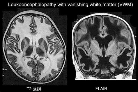 Periventricular White Matter Disease Differential Diagnosis - Pregnant ...