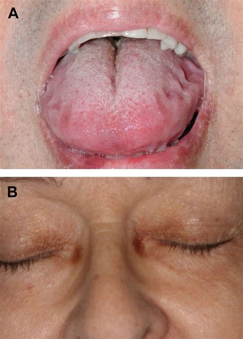 Amyloidosis A Macroglossia With Characteristic Crenations Along