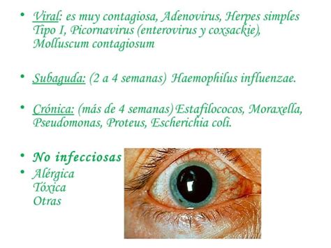 Conjuntivitis Ppt