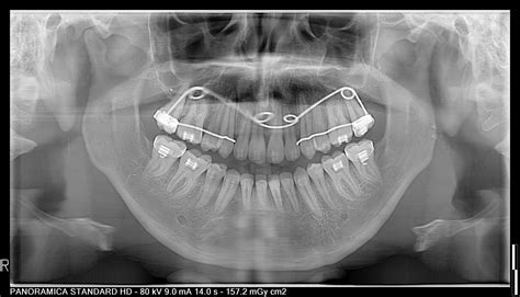 Micrognathia? : r/jawsurgery