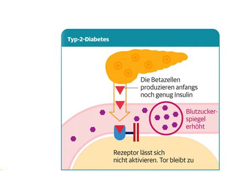 Diabetes Mellitus Typ 2 Apotheken Umschau