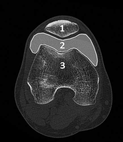 Ultrasound For Knee Effusion Lipohaemarthrosis And Tibial Plateau Fracture Rippey 2014