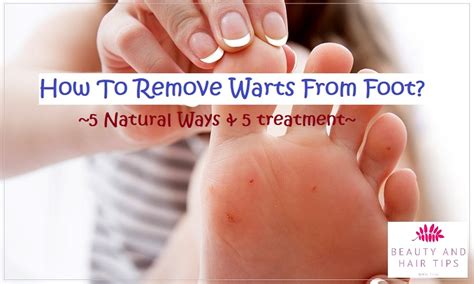 How To Remove Warts From Foot? - 5 Home Remedies & 5 Treatment!