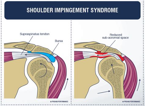 Pinzamiento Subacromial En El Hombro Mundo Entrenamiento