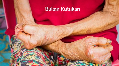 Kusta Penyakit Kutukan Jangan Mudah Percaya Simak Dulu Faktanya