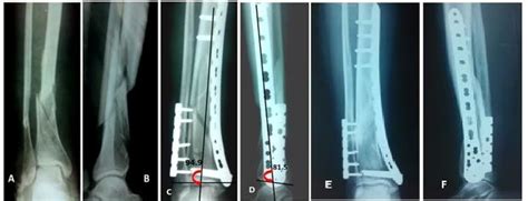 56 Years Old Male With Ao Type 43a3 Pilon Fracture A Preoperative Ap