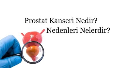 Prostat Kanseri Nedir Nedenleri Nelerdir G Zel Bilgiler