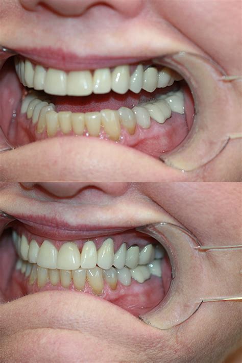 TMJ Treatments Gallery Before & After Patient 56 | TMJ Expert