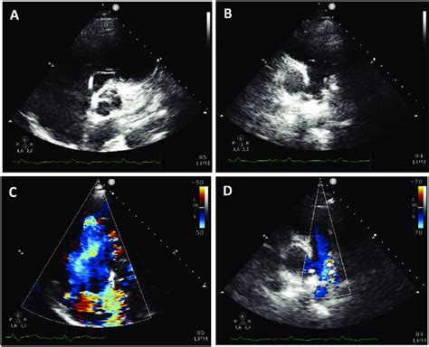 Echocardiographic Views After The Impella RP Insertion A