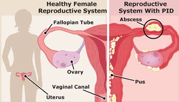 Pelvic Inflammatory Disease Pid Doral Health And Wellness Womens