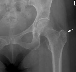 Greater Trochanteric Pain Syndrome Diagnosis and Treatment ...