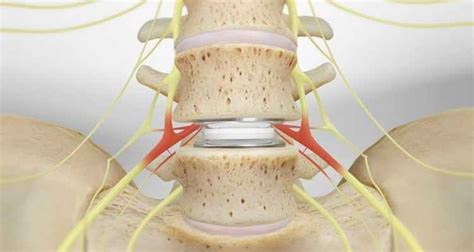 What Is Artificial Disc Replacement Everything You Need To Know