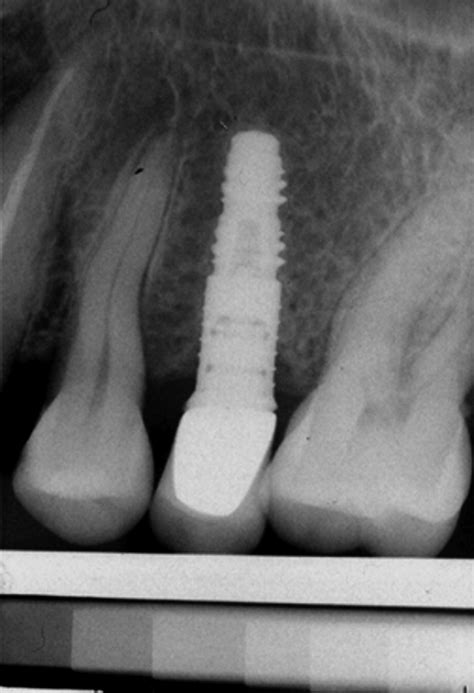 Postoperative Periapical Radiograph 12 Months After Implant Placement