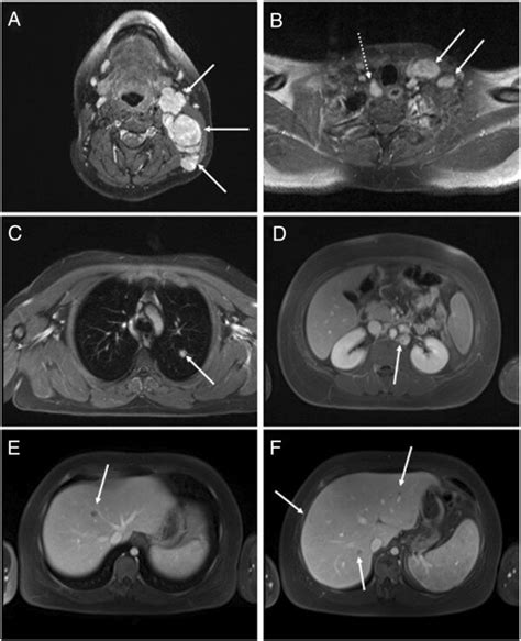 Initial radiologic staging confirming lymphoma Ann Arbor stage IV. (A)... | Download Scientific ...