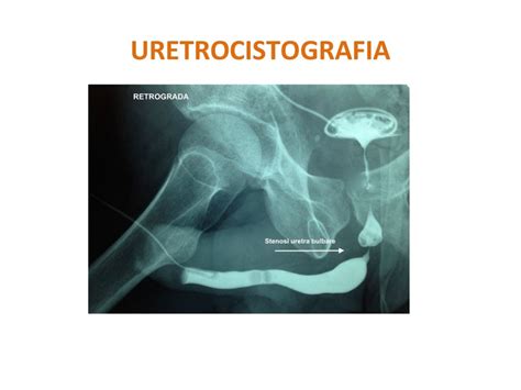Uretrocistografia Retrógrada E Miccional - Uretrocistografia Miccional E Retrógrada - RETOEDU