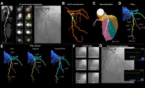 JACC Cardiovascular Interventions Vol 16 No 7