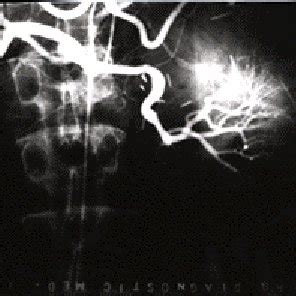 Postoperative Angiogram Showing Widely Patent End To End Splenic Artery