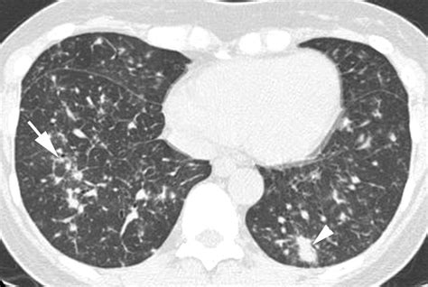 Challenges in pulmonary fibrosis · 1: Use of high resolution CT ...