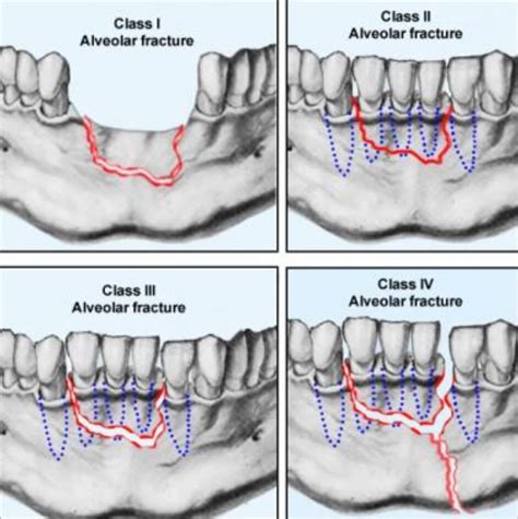 Alveolar Ridge