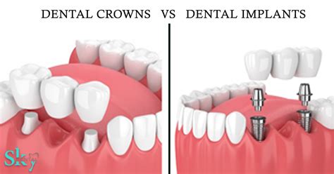 Dental Crowns Verses Implants Sky Dental Care