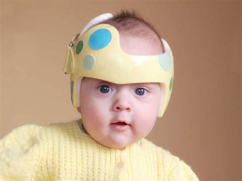 Positional Plagiocephaly Before And After