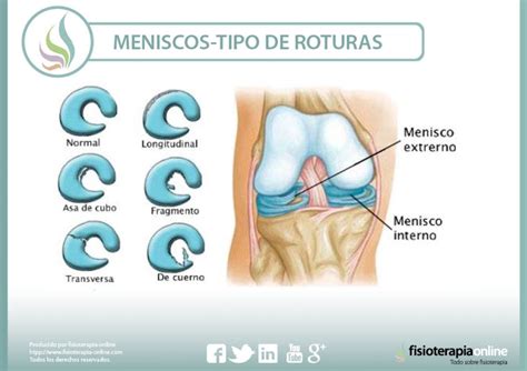 No Hay Dos Rodillas Iguales Ni Dos Lesiones De Menisco Iguales Aprende Algunas Diferencias