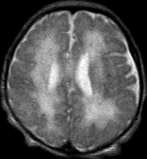 Hypoxic Ischemic Brain Injury Imaging Findings From Birth To Adulthood