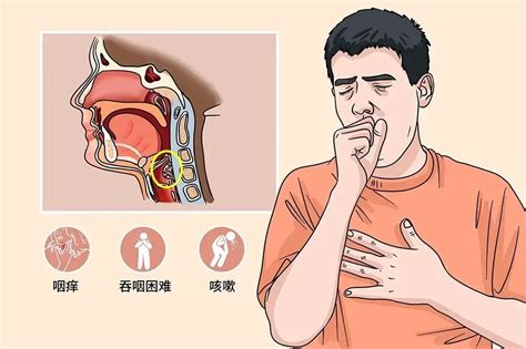 秋季高发如果你有咽干咽痒吞咽异物感十有八九已中招 咽喉炎 症状 咽部 患者 健康界