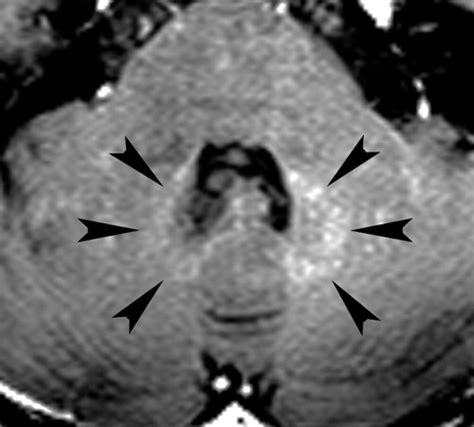 Dentate Nucleus Mri